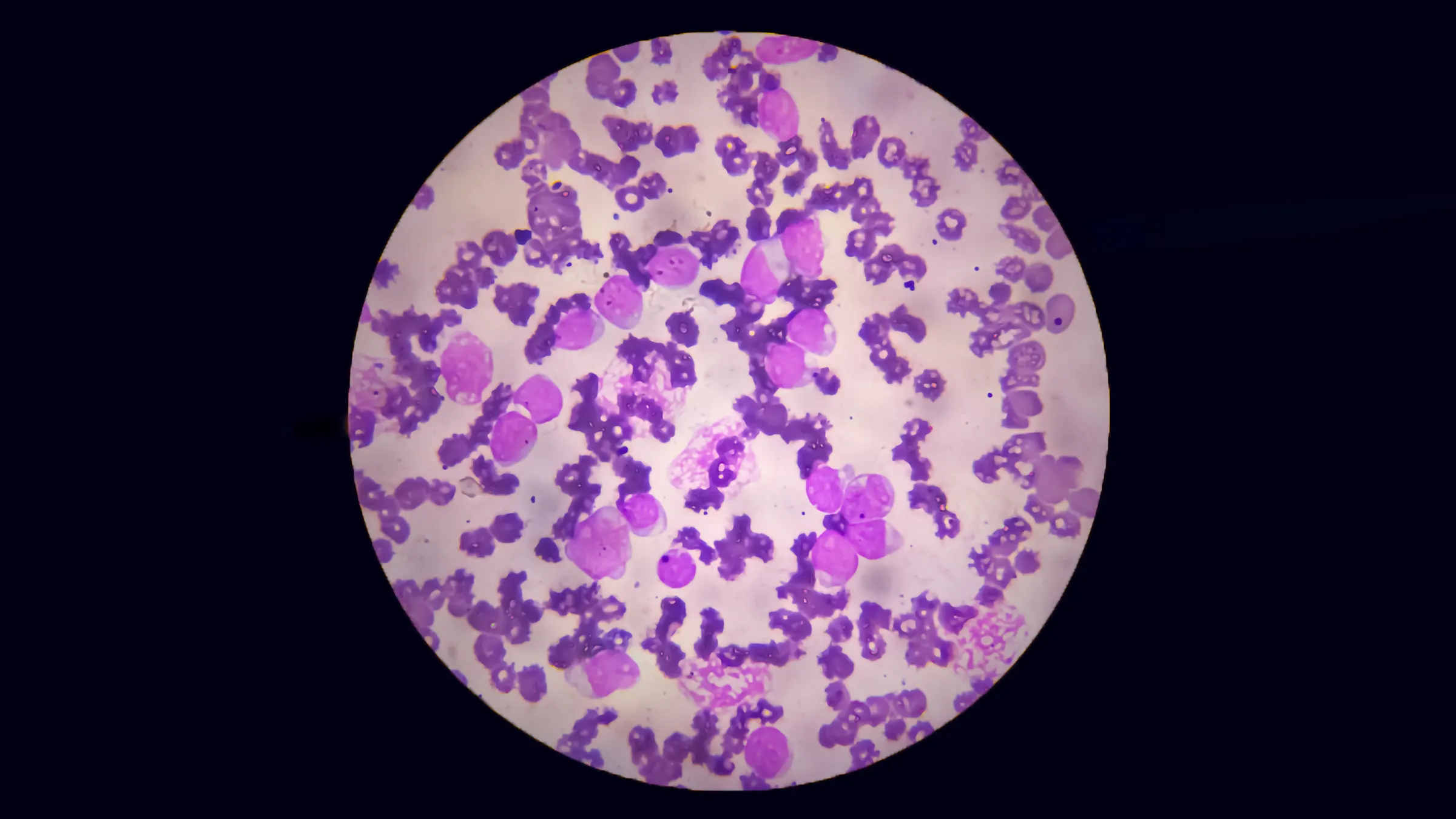 Microscope sample of a peripheral blood smear diagnosis of acute leukemia.