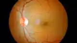 Oftalmologia grazie al colore (immagine della retina)
